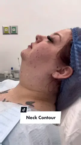 Thanks for trusting us @imabbydff 🥰 This is Neck Contour, Cardé’s exclusive technique, which offers a mandíbular profiling, eliminates the double chin and does not produce saggines. 😃🙌🌟  Do you want to get your your Neck Contour done? Call us at: 🇺🇸 915 345 3021 🇲🇽656 597 4272 🫶🏻☺️✨  #lipopapada  #lipoescultura #liposcultura #lipo  #neckcontour  #cardeume  #drflores  #dracastillo  #doblechin  #beforeandafter  #chinlipo  #liposuction  #lipocheck  #cardeume  #fyp  #fypシ  #lipopapadacheck  #lipohd  #doublechin  ##nyc  #LA  #phx  #beforeandaftermakeup  #liposculpture  #neckcontour #jawlin #jawlinecheck #jawline  