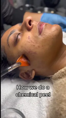 There are many steps that go into a chemical peel, and I’m just showing you a few of them now. If you’re interested to learn more, I have a ton of these videos I can create for you especially if you’re an aesthetician. We specialize in chemical peel because they offer our clients dramatic results very quickly with almost every skin concern and time. I’ve done over 20,000 of them in my career and I believe them to be an underrated service that offers so many benefits. Are you in Aesthetician? Looking to learn more about chemical peels? Let me know I can start sharing on my professional content on this page. ❤️ you. #estheticiantraining #estheticianstudents #newesthetician #skinpeels #chemicalpeeltraining #chemicalpeeleducation #advancedesthetician #estheticiansbelike #acnepeel #adultacneisreal #adultacnehelp 