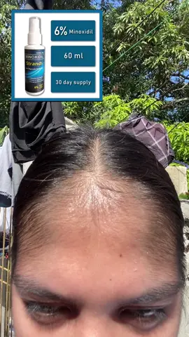 Super effective and legit 👏⬇️💯 #minoxidil #minoxidilstrands #minoxidilresult #affiliatemarketing #affiliatemarketingforbeginners @StrandsMinoxidil ♥️