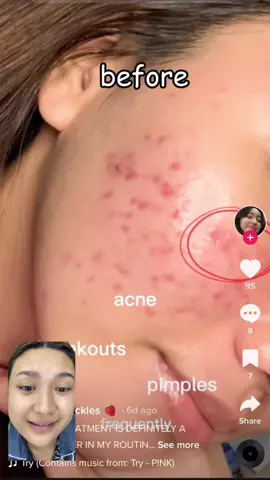 Salicylic Acid 🤝 is the key! #effective ✨ @Skintific.ph @Karina Eunike #skintific 