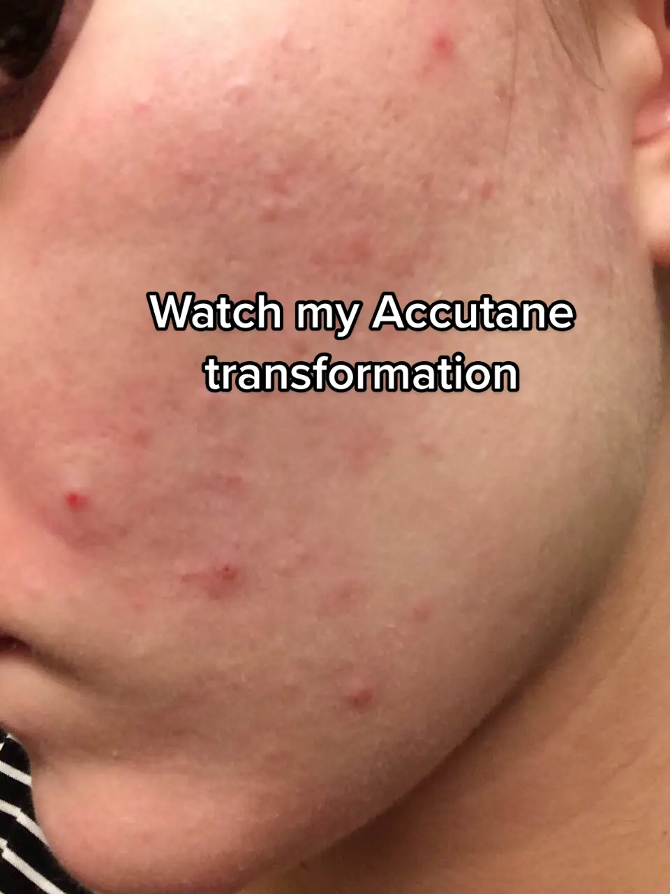 Acne is one of the most frustrating things to deal with. Hopefully my skin journey can inspire you! Lmk if you havw questions! #accutane #accutanecheck #accutanejourneyy #accutanepurge #accutanetips #acne #acnetreatment #accutaneresults #accutanegang 