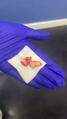 Wisdom tooth removal 🦷 #grwm #wisdomteethremoval 