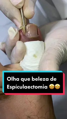 #podologia #podologa #podologo #unha #ingrowntoenail #nail #videosnapchallenge #videosatisfatorio #satisfatorioasmr #satisfatório #asmr #asmrsounds #asmrvideo #asmrtiktoks #saude #unhaencravada #unhainflamada #unhainfeccionada #unhaencravada2022 #unhaencravada2021 #alivio #podologomaurelio #foryou #vaiproforyou #viraltiktok #viralvideo #viral #satisfation #satisfying #satisfyingvideo #uña #uñaencarnada #manicure #pedicure 