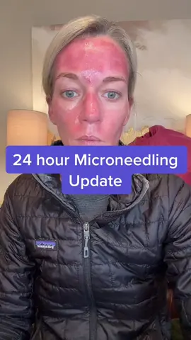 24 hour update after my Microneedling treatment! #microneedlingtreatment #microneedlingface #skintreatments 