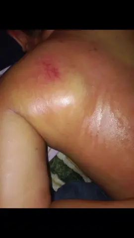 urat belikat yg membuat sakit punggung&susah bernafas