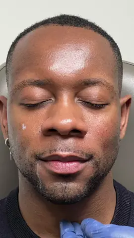 Watch the transformation! 🤩 male masculinization using fillers 💉✨👦➡️🧔‍♂️ #fillers #jawlinefiller #chinfiller #jawline #manly #snatched #chin #injector #rnericnietzel #galderma #allergan #gym #Fitness #fyp #scienceandbeauty #fillerinjection #maleface #jawfiller #faces