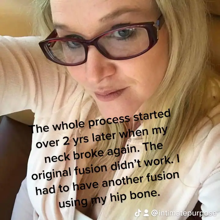 Warning: Surgery scars… 2 yrs after the original surgery, my neck broke again. The original fusion did not take and broke into 100’s of pieces. I was back in surgery within 2 wks of finding the damage which required super invasive testing. This time they took a piece of my hip bone with my insistence so my body would not reject it. I still had nerve damage but my neck was finally fixed as well as it could be. #c#caraccidentsurvivor❤️💜b#brokennecksurvivors#spinalfusionn#necksurgeryr#radiofrequencyablationn#nervedamagesucksc#chronicpainwarriorn#ndementalhealthmatters 