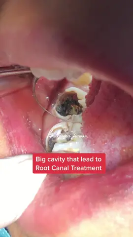 Big cavity 🦷 requires a rct! #drfaiquaanwar #anwarsaeeddentistry #calculusslayer #foryou #fyp #fy #foryoupage #fypシ #trending #viral #dentist #teeth #CleanTok #beautiful #rct 