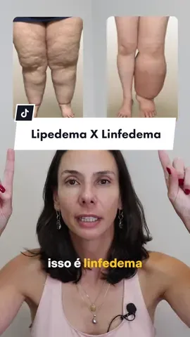Diferença de LIPEDEMA e LINFEDEMA  #paravoce #lipedema #linfedema #cirurgia 