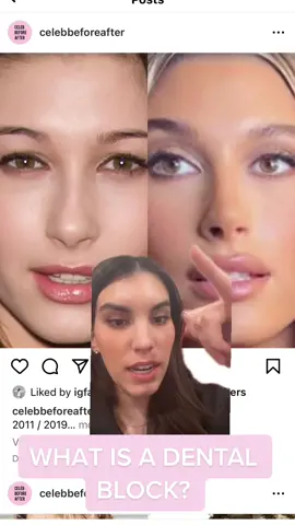 please let me know what your experience was I’m curious! Dental block or took it like a champ? #greenscreen #lipfiller #lipfillergonewrong #fillersgonewrong #lipfillerbeforeandafter #haileybieber #haileybaldwin #haileybieberlips #bornorbought #realorsus 