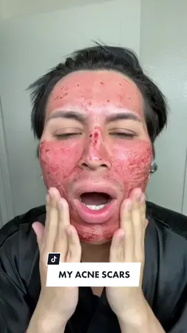 Would you try this acne scar treatment? 😱 I did microneedling with the biopelle serum I showed in this video ✨ #acnescars #acnescartreatment #microneedling #morpheus8 #acne #acnescarremoval #skincare #skintreatment #beauty 
