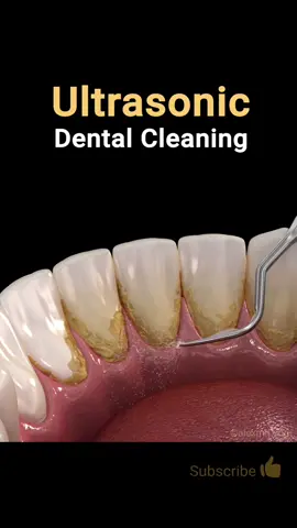 Ultrasonic dental cleaning, 3d animation.  #dental #tooth #teeth #dentist #hygiene #dentalhygienist  #dentistry #dentalschool #dentalstudent #dentistryworld 