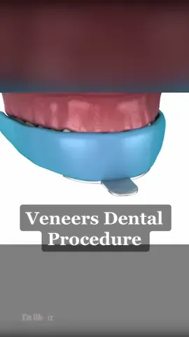Veneers Dental Procedure #3d #animation #veneers #dentist 