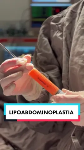 Lipoabdominoplastia HD com a técnica RAFT que utiliza enxertos de gordura nos músculos abdominais para maior definição muscular e valorização da anatomia. Dr. Ricardo Proto Cirurgião Plástico CRMSP 120.203 RQE 54.056 ✅AGENDE sua consulta presencial ou on-line (telemedicina): 📲WhatsApp: (15) 99619-5010 📞Telefones: (15) 3211-0807 / 3211-1715 🔹Realizamos nossas cirurgias em Sorocaba e São Paulo🔹 #ricardoproto #cirurgiaplastica #cirurgiaplástica #cirurgiaoplastico #cirurgiãoplástico #renuvion #renuvionsoroc