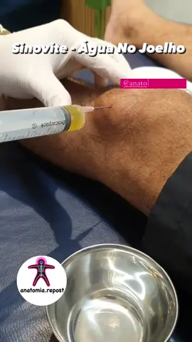 Popularmente conhecida como “água no joelho”, a sinovite é um problema que acomete muitas pessoas. Essa famosa expressão se refere à sensação de quando o joelho fica inchado e acumula líquido em seu interior.  A água no joelho é uma condição que se caracteriza pela inflamação da membrana sinovial, uma camada fina de tecido conjuntivo que reveste estruturas como tendões musculares, cápsulas articulares e bolsas sinoviais.  O líquido sinovial, presente na membrana sinovial, é o principal agente responsável pela lubrificação e nutrição de todas as partes internas do joelho, cartilagem, menisco e ligamentos. Além disso, o líquido sinovial possui células de defesa que protegem contra microrganismos patológicos que possam atingir a membrana. Em casos de trauma ou processo inflamatório, por exemplo, esse líquido aumenta no joelho, levando à inchaço e dor. Daí surge a expressão água no joelho. Traumas diretos, uso excessivo ou repetitivo da articulação, infecção e doenças reumáticas que influenciam na destruição do tecido (como artrose, por exemplo), estão entre as principais causas para a inflamação que ocorre na água no joelho. Após o diagnóstico, o médico ortopedista irá orientar o tratamento mais adequado de acordo com os sintomas relatados pelo paciente. 