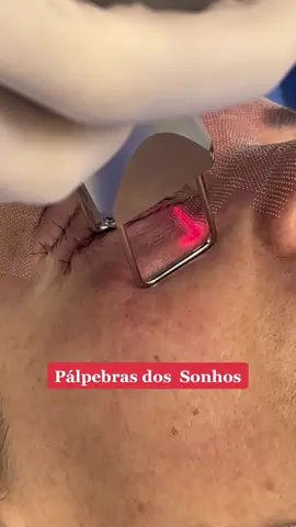 Blefaroplastia das Pálpebras associado ao Laser CO2 Fracionado! #resurfacing #blefaroplastia#cirurgiadaspalpebras #rejuvenescimentodoolhar #laserco2  