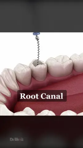 Root Canal Treatment, What To Expect #3d #animation #rootcanal #rootcanaltreatment #dentist 