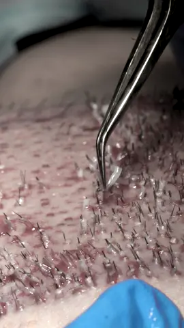 ¿Siempre has deseado tener una barba abundante, pero tienes poco vello facial? El transplante de barba es el procedimiento ideal para ti!!  Ingresa al link de la biografía para realizar tu consulta virtual gratis 🙌🏻🙌🏻 #hairtransplant  #care4hair   #miamihairimplant  #neograft  #hairgraft  #hairloss  #hairgrowth  #hairtreatment  #miami  #hairimplant #prp #transplantecapilar #implantecapilar #fuehairtransplant 