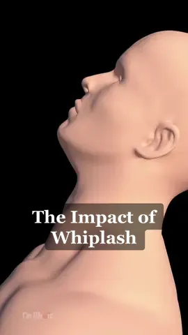 The Impact of Whiplash #3d #animation #whiplash #health 