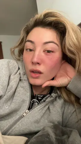 Hopefully this leads me to stye Tiktok 🙄 #fyp #stye #eyeinfection #styetreatment #styeremedies #eyeinjury #wlw #lgtbq🏳️‍🌈 