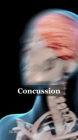 Concussion: Here’s What It Does To The Brain #concussion #brain #braininjuy #3d #animation 