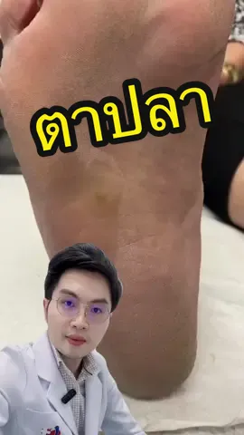 ตาปลาที่เท้า @ergonx / docpods  #หมอตี๋ #หมอผิวหนัง #รู้หรือไม่ #สาระความรู้ #TikTokUni #ตาปลา #corn 