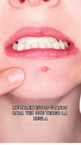 No es normal que a mi edad siga teniendo granos con la regla !!!! Siento decirte q esto es bastante habitual . Debido a los cambios hormonales que experimentamos durante el ciclo no es nada infrecuente que tras la ovulación o antes o durante la regla nos salgan granos , incluso teniendo ya 30-40 años . Pero te animo !!! No te conformes !!! Cada grano q sale es inflamación mancha marca . Haz algo para no tener q aguantar esto todos los meses . Te  podemos  ayudar a mejorar la calidad de tu piel 😍🙏🏼🙏🏼 ⁣ WHATSAPP- Envíanos un mensaje con tus dudas, te ayudo con tu rutina cosmética 601 370 561⁣ carmengalera@dermaforyou.com⁣ ⁣⁣⁣ ⁣ #dermatologiaestetica #dracarmengalera #dermatologia #dermatologiaclinica