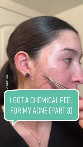 Replying to @Tallita Westin skin is looking amazing already 😍 #day5 #update #chemicalpeel #chemicalpeeljourney #satisfying #part3 