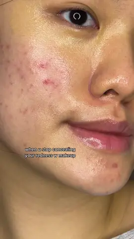 jdi cepett bgt meredanyaa ahh luuv niacinamide for redness😩✊🧡 #skincaretips #skincareroutine #acne #acneskin #acnetreatment #niacinamide #pakaisomethinc 