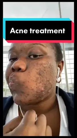 #stitch with @Leslie kash🌹 Severe acne is a medical condition and should be treated as such, by a doctor! When acne is this severe the risk of permanent scarring is high, the earlier you start treatment, the better. #acne #severeacne #acnetreatment #acnetransformation #dermatologist #dermatologistexplains #roaccutane #accutane #isotretinoin #isotretinoinjourney 