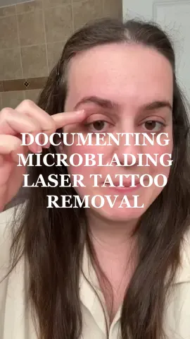one month of healing from my most recent laser tattoo removal on old microblading! #lasertattooremoval #microbladingfail #microblading #microbladingbrows #microbladingremoval #microbladinglaserremoval #deinfluencing 