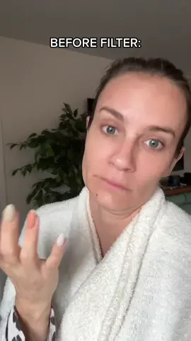 Let’s see what the viral bold glamour filter does to my wrecked face after a chemical peel. 🤯 It turned a cystic pimple into a beauty mark. BELIEVE NOTHING YOU SEE ON THE INTERNET 😳 #beforeandafter #boldglamourfilter #cysticacne #chemicalpeeljourney #fake 