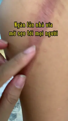 Kem sẹo xứng đáng sở hữu chính là kem mờ sẹo Actiscar