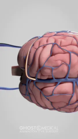 Synchron's stentrode™ is a neural interface designed to overcome ##paralysisby creating a digital bypass from the ##brainto an assistive device. Direct brain control of a mouse, a keyboard and even vehicles may become possible ##technologyto restore. #medicaltiktok #awareness 