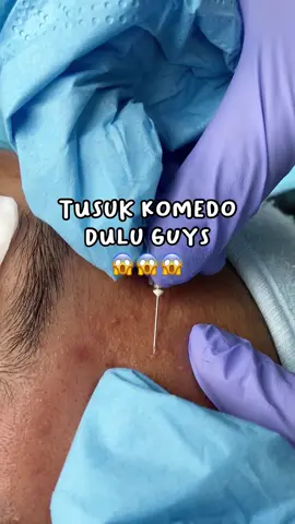 Siapa disini yang ngerasa punya komedo tapi susah banget keluarnya? Dan kalo dipegang kayak butiran-butiran keras gitu?  Ini namanya close comedo atau komedo tertutup ya guys, salah satu cara mengeluarkannya bisa ditusuk jarum seperti ini. Eitsss tapi jangan asal lakukan sendiri dirumah yaa, tindakan ini harus dilakukan dengan yang ahli 😉 📍 @karadentabandung_kopo  📍 @karadenta.tangsel  📍 @karadenta.mlg  📍 @karadenta.surabaya  📍 @karadentabandung_katamso  📍 @karadentabandung_sukaluyu  📍 @karadenta.samarinda #karadentahouseofbeauty #karadenta #treatment #perawatan #perawatanwajah #komedo #fakesituation⚠️ 