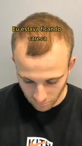 Já ta na hora de ficar mais atraente e parar de ser chacota e piada!! #calvo #calvice #minoxidil #folixil #foryoupage #fyp #tiktok #vaiprofycaramba #viral 