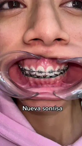 Estrenamos sonrisa🤩#ortodoncistaentiktok #dentistaentiktok #2023 #marzo #perritos 