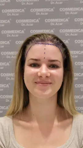 World’s best woman hair transplant result in Cosmedica Clinic by Dr. Acar. Our patient’s 9 month hair growth after a successful 2500 graft operation. We love telling our patients’ success stories.