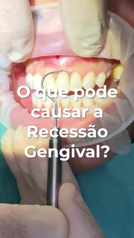Faz muita força a escovar os dentes? Saiba que pode ser um forte candidato à Recessão Gengival 😬

Conheça as causas deste problema!

#aesteticdentistry #gumsurgery #dentalsurgery #smilemakeover #smiledesign #tranformaçãodosorriso #dentalcare #recedinggums #recessaogengival 