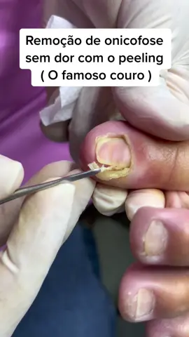 Peeling na podologia, remoção de onicofose sem dor . #podologia#unha#unhasencravadas❤️ #onicofose 