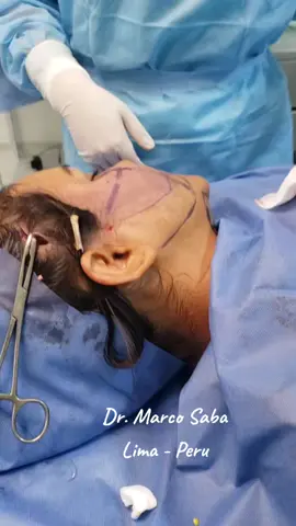 #miniliftingfacial  #lifting  #liftingfacial 