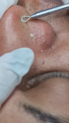 #extractions #extracaodecravos #limpezadepeleprofunda #pelelimpa #cravoseespinhas 