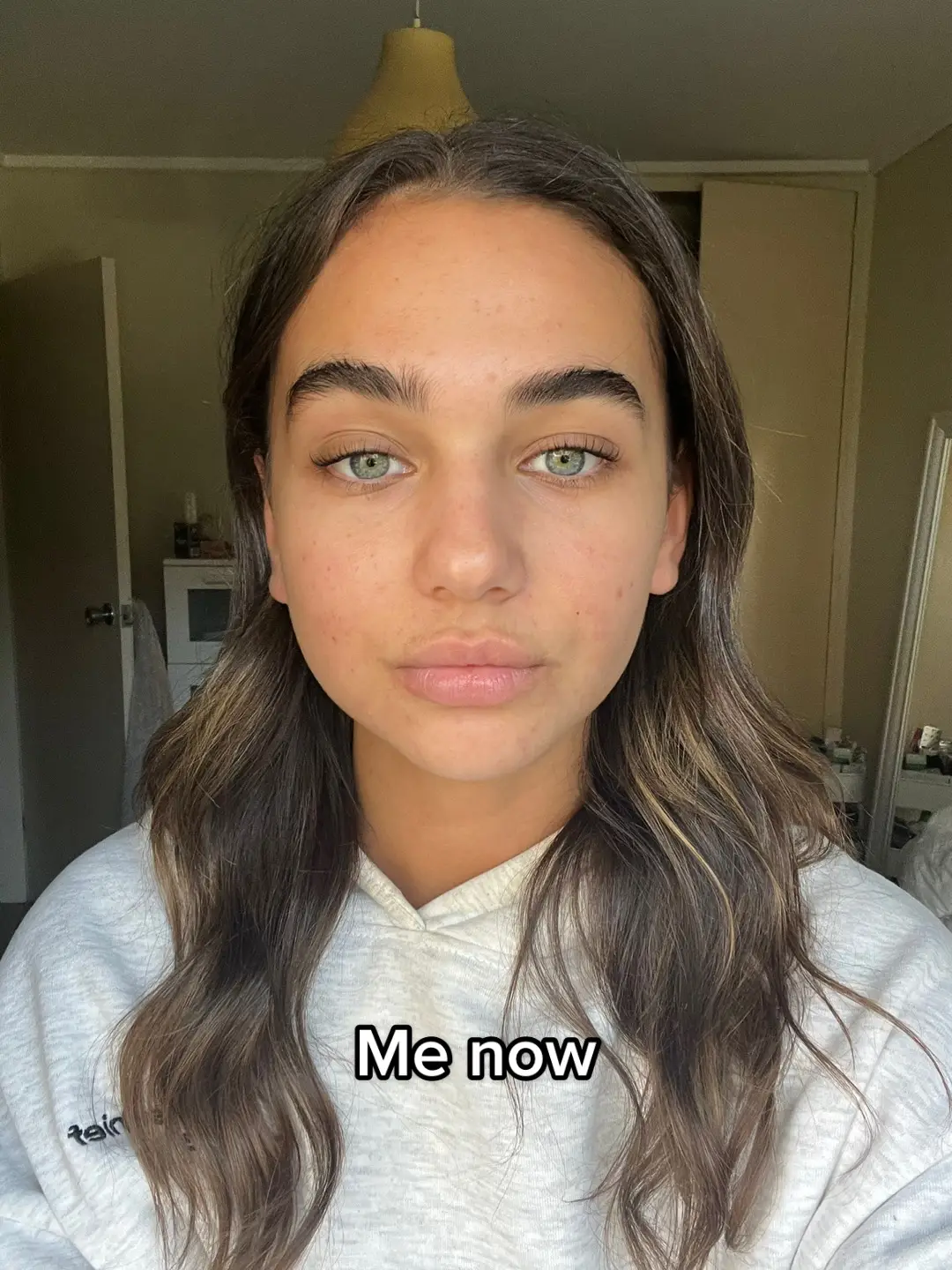 Really hard for me to share these pics but I think its important to normalise the yucky parts of having skin issues. It’s so easy to hide this stuff on social media m but so many people experience it. Still a long way to go but we’ll get there 💅🫶🏼💘 #acne #cysticacne #retinol #retinolskincare #acnejourney #women 