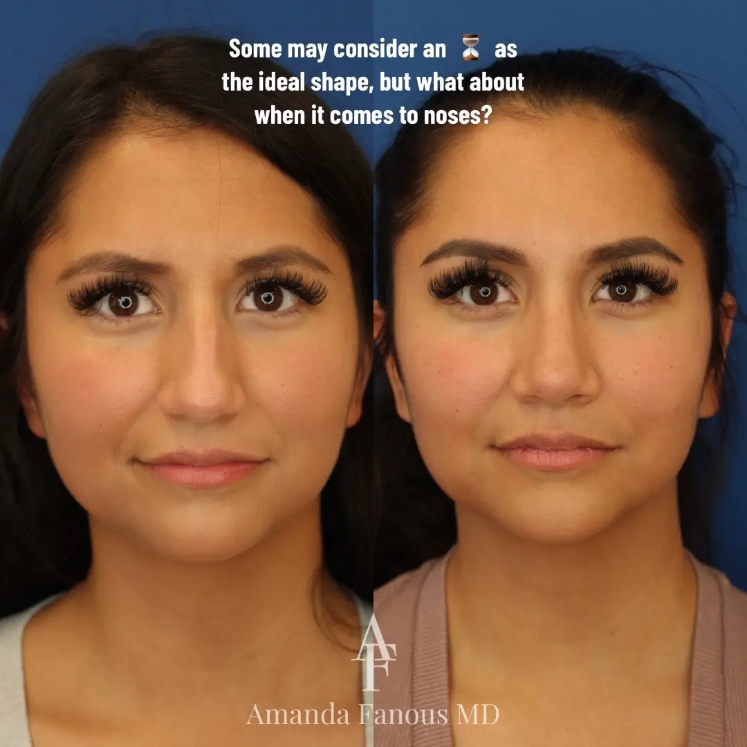 Some may consider an hourglass  ⏳  as the ideal shape, but not when it comes to the nose  👃  - which is exactly what this patient had when assessing her frontal view.  Through the use of the ultrasonic tool, I was able to narrow out the wider parts of her nose giving her a more symmetrical frontal view, without creating a pinched appearance. ps: Can we take a moment to appreciate the lashes on my beautiful patient!? #femaleplasticsurgeon #mtltiktok #mtlsurgery #facialplasticsurgery #cosmeticsurgerytiktok #nosejobbeforeandafter #nosejobtiktok #rhinoplastyspecialist  