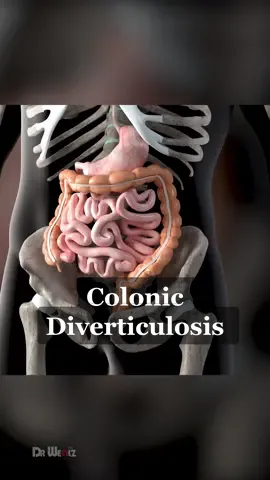 Colonic Diverticulosis #diverticulitis #diverticulosis #colon #intestinaldisorders 