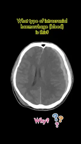 Intracranial haemorrhage on CT brain. Extradural vs subdural haemorrhage. The answer: @Dr Azku | Radiologist  #radiologyquiz #imagingdiagnosis #brainbleed #traumaticbraininjury #emergencymedicine #frcr #medstudent #catscan
