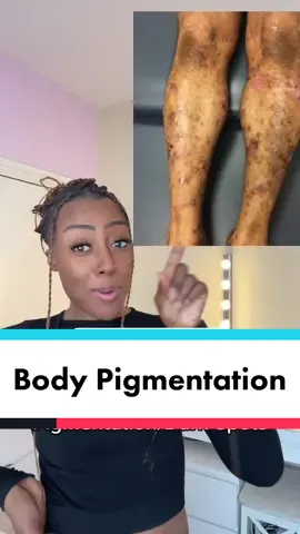 Reducing Body Pigmentation With The  BEST BODYCARE PRODUCTS 🙌🏾 #bodycare #darkskin #blackskin #darkspots #bodypigmentation #bodyscars #DarkSkinTips #BlackBeauty #SelfLoveBlackGirl 