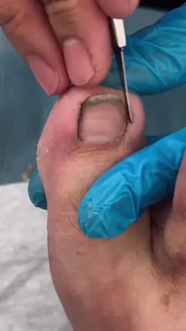 Dirty nail cleaning #fyp #fypシ #pedicure 