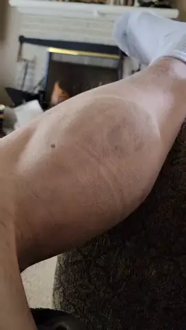 CALF MUSCLE SPASMS 