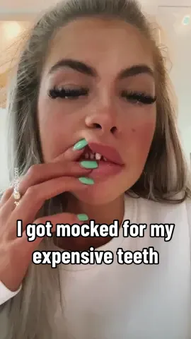 I paid so much for my new teeth, but not everyone agrees they were worth it 😬 #veneers #turkeyveneers #newteeth #veneersjourney 